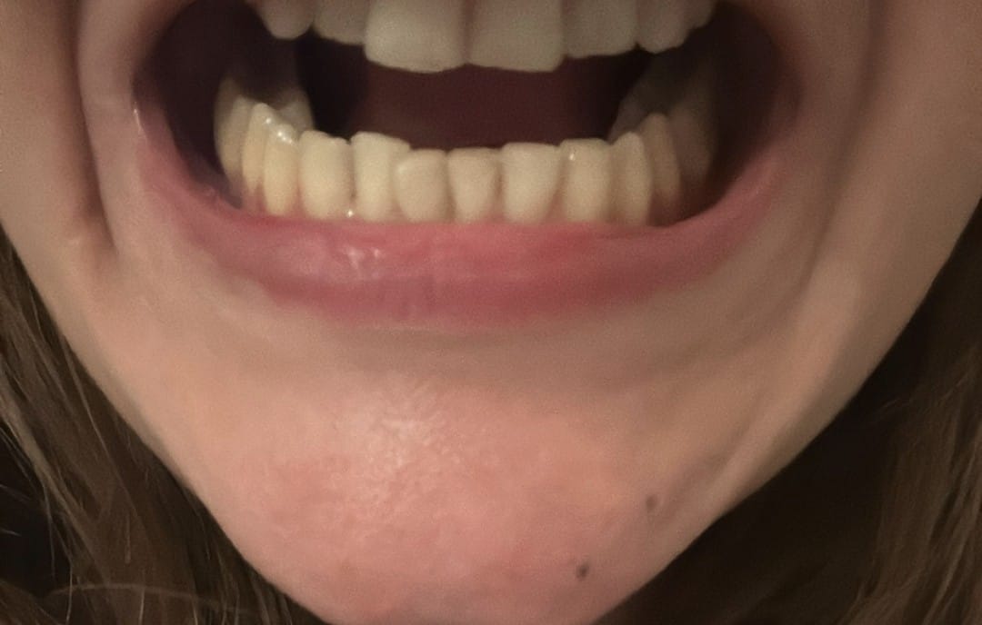 A finished lower arch one year after debond, showing measurable three-dimensional relapse of the anterior teeth.